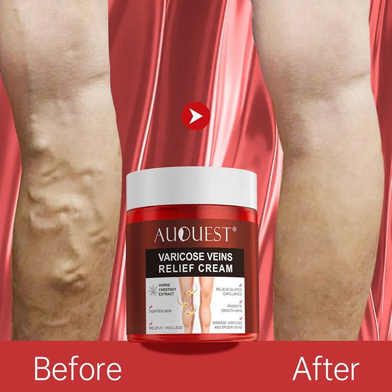 Varicose Vein Cream: Exclusive Herbal Relief for Best Results